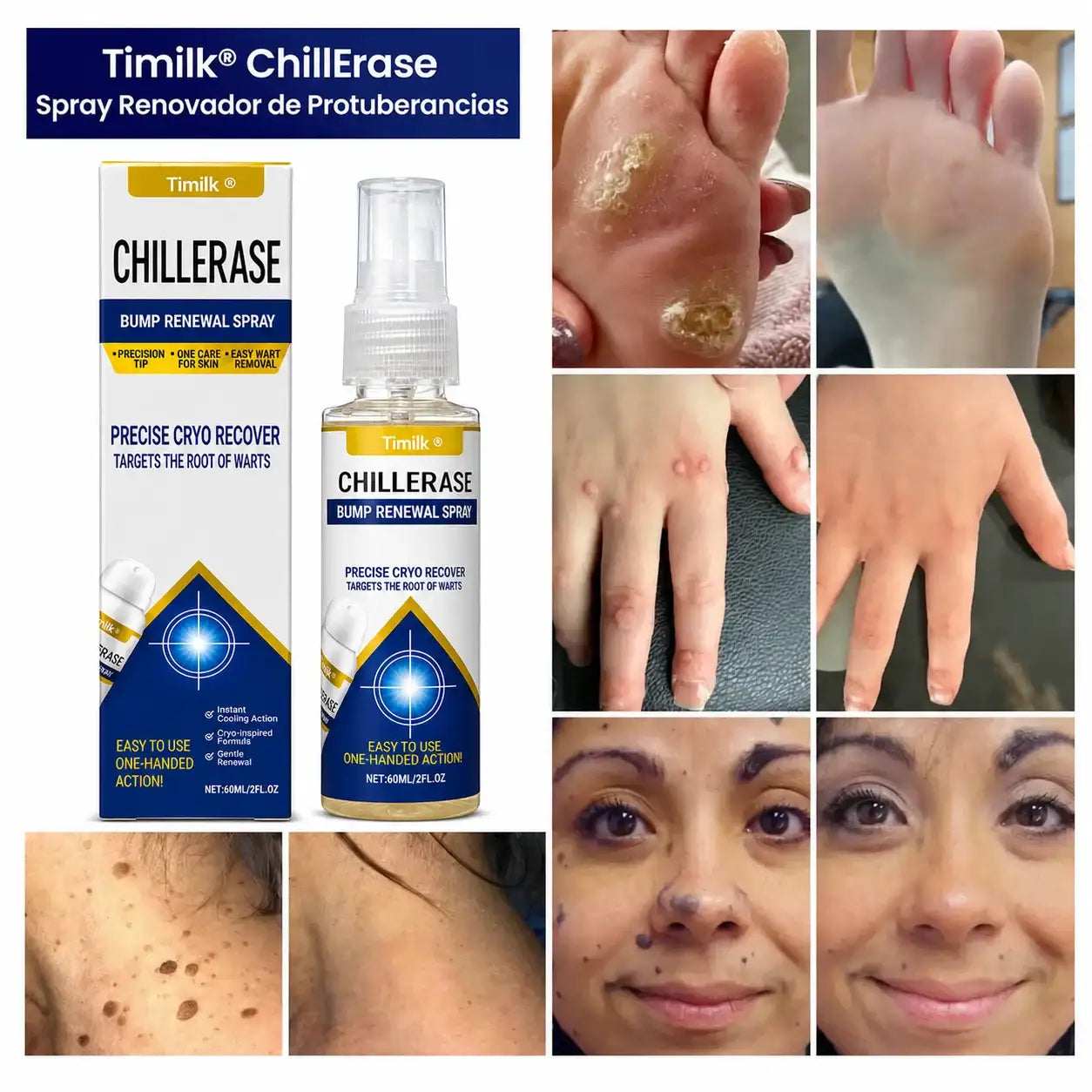 ChillErase Spray de Verrugas